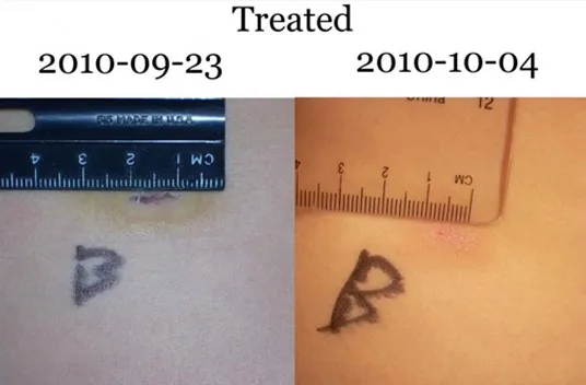 Treated wound 