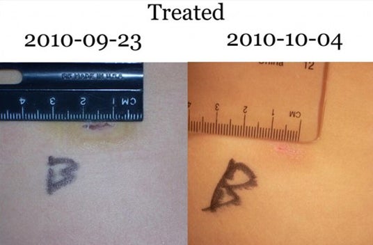 Treated wound