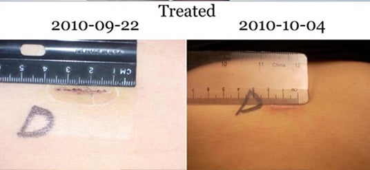Treated wound